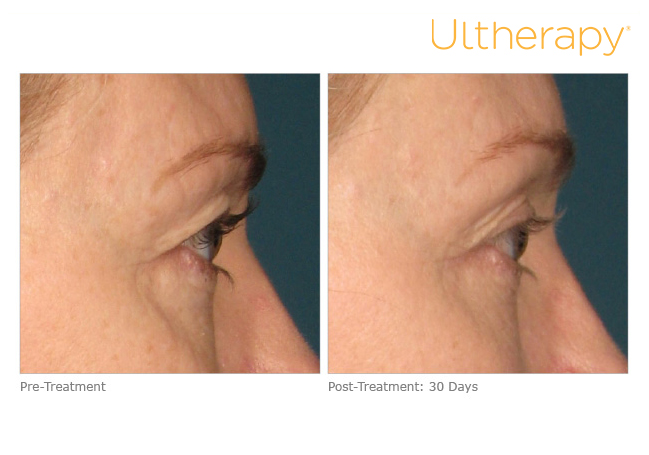 Non-Surgical Ultherapy